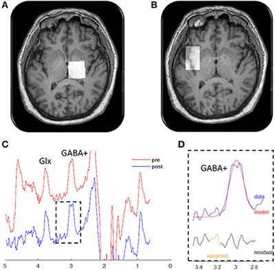 Cervical Dystonia Is Associated With Aberrant Inhibitory Signaling Within the Thalamus